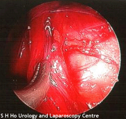 Treatment for Varicocele laparoscopy laparoscopic